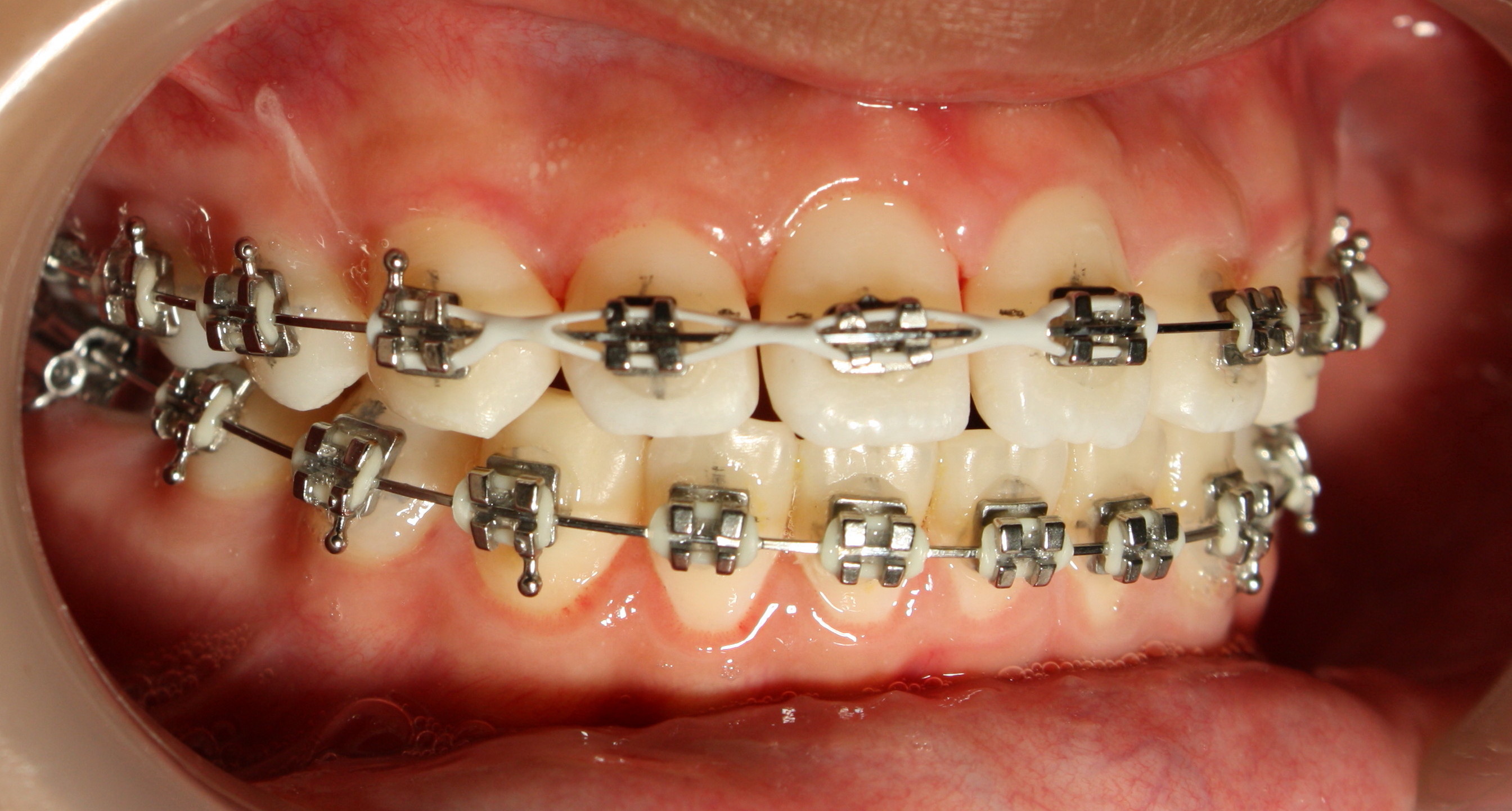 Oral hygiene and braces